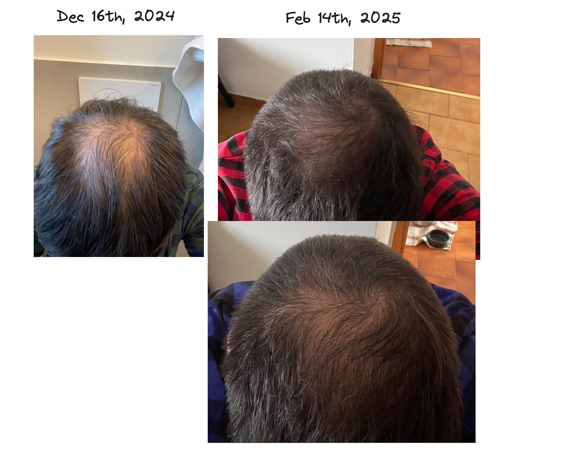 hair loss improvement progress